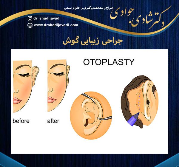 عکس جراحی زیبایی گوش - دکتر شادی جوادی