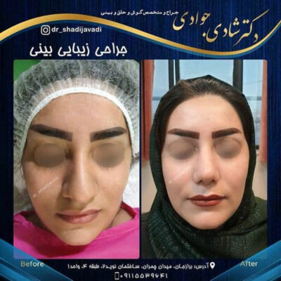 جراحی بینی - دکتر شادی جوادی