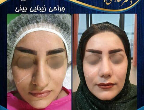جراحی بینی در شیراز همراه با عکس و فیلم