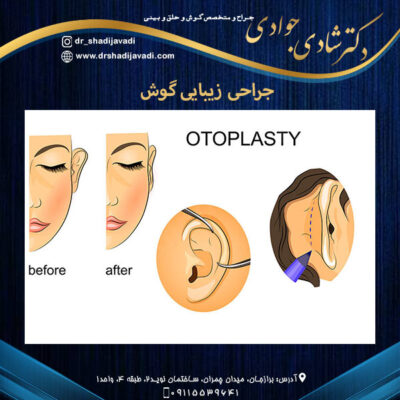 جراحی زیبایی گوش - دکتر شادی جوادی