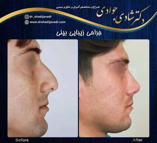 جراحی بینی استخوانی - دکتر شادی جوادی