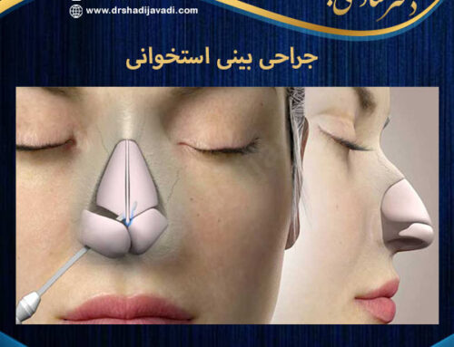 جراحی بینی استخوانی + دکتر شادی جوادی