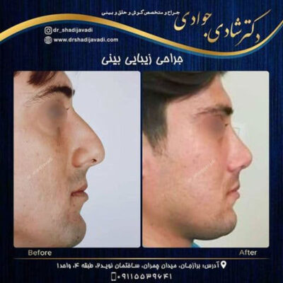 جراحی بینی شیراز - دکتر شادی جوادی