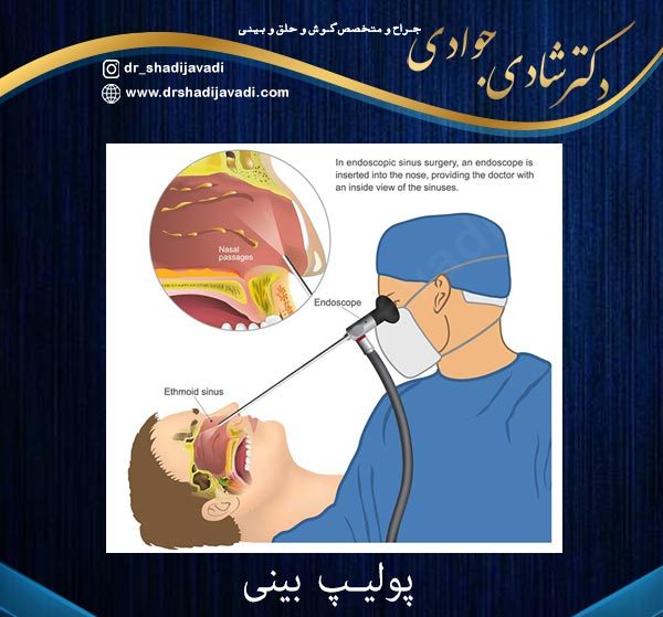 پولیپ بینی - دکتر شادی جوادی