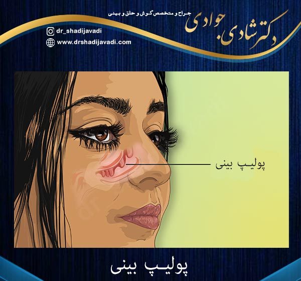 پولیپ بینی - دکتر شادی جوادی