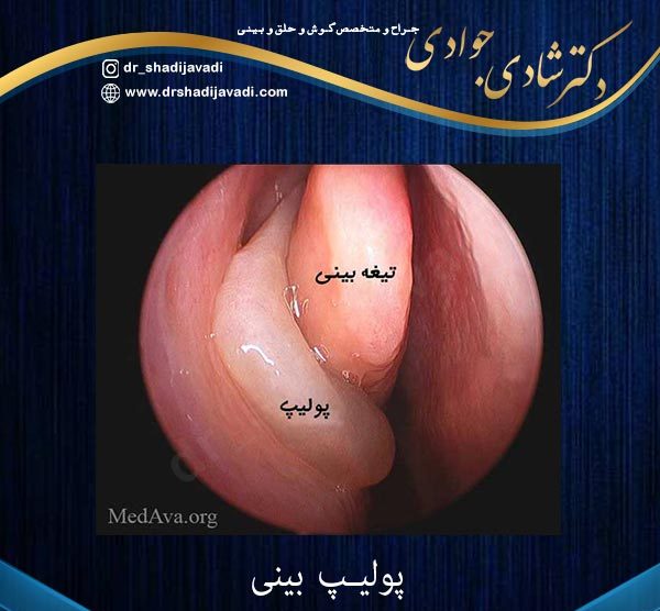 پولیپ بینی - دکتر شادی جوادی