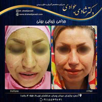 جراحی بینی گوشتی - دکتر شادی جوادی