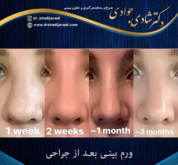 ورم بینی بعد از جراحی - دکتر شادی جوادی