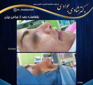جراحی بینی طبیعی