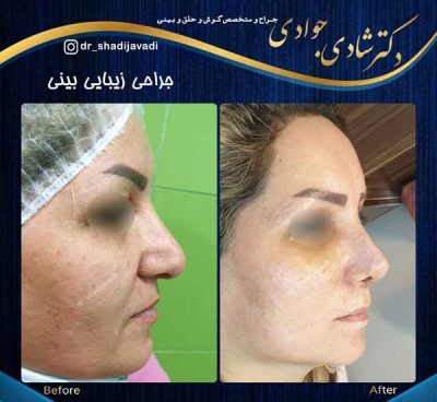جراحی بینی طبیعی - دکتر شادی جوادی