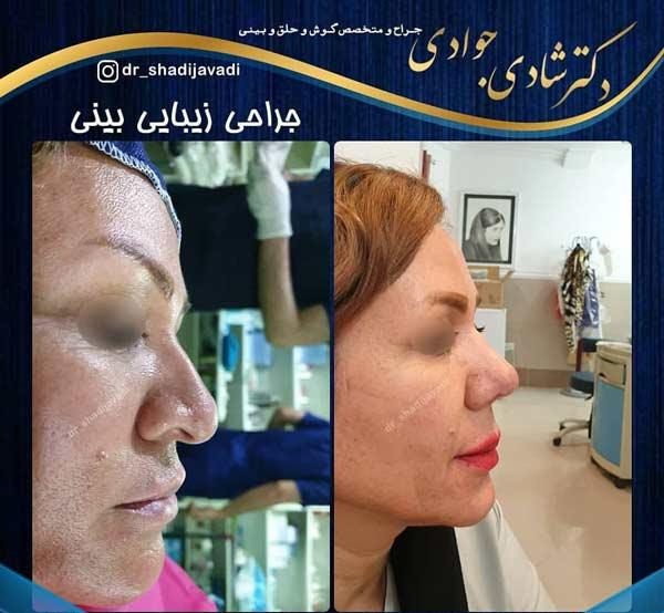عکس قبل و بعد جراحی بینی طبیعی