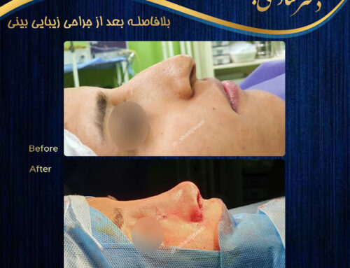 جراحی بینی فانتزی در شیراز