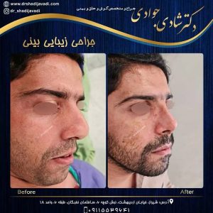 جراحی بینی مردان - دکتر شادی جوادی