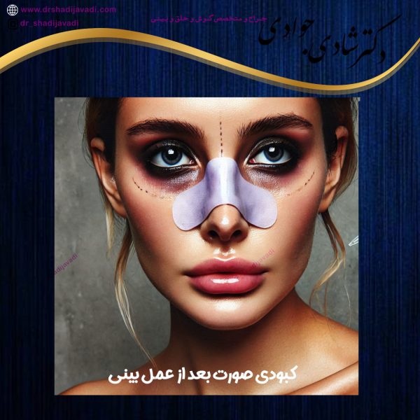 کبودی صورت بعد از جراحی بینی - دکتر شادی جوادی
