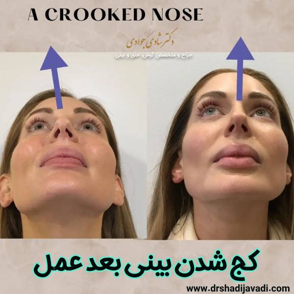 کج شدن بینی بعد عمل