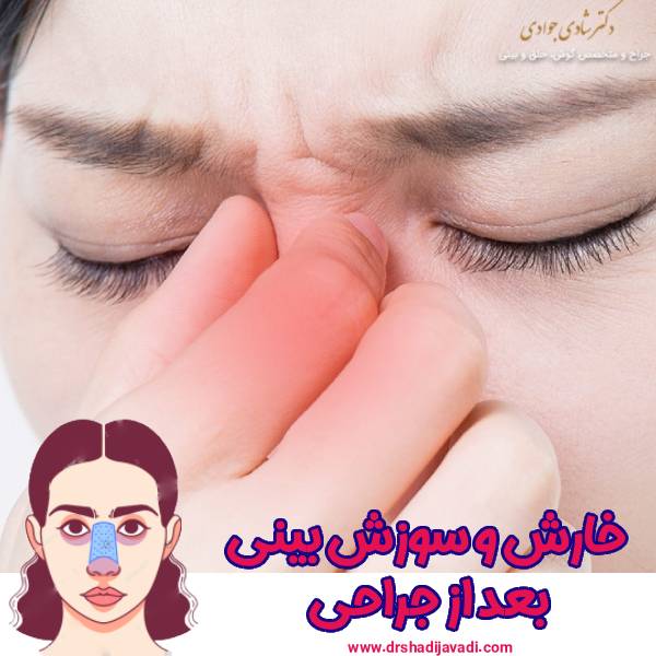 خارش-و-سوزش-بینی-بعد-از-جراحی-بینی - دکتر شادی جوادی