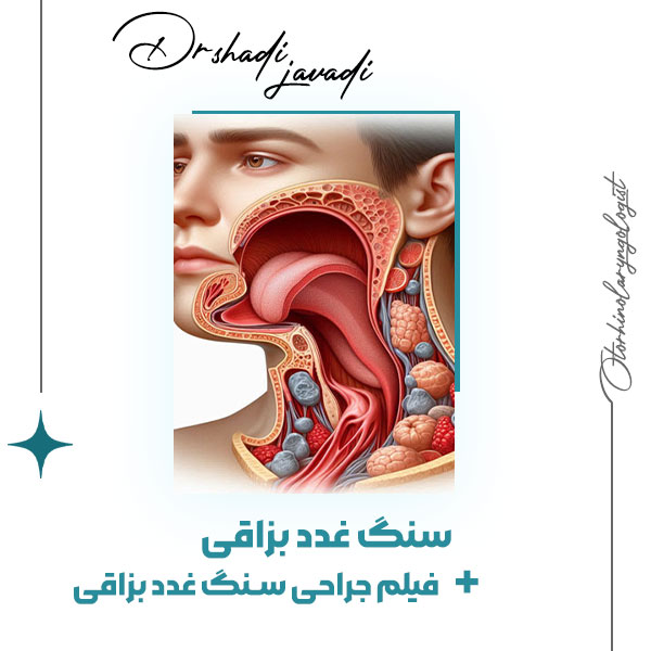 سنگ غدد بزاقی - دکتر شادی جوادی