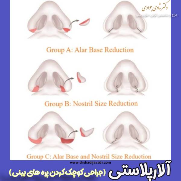 عکس آلارپلاستی - دکتر شادی جوادی 