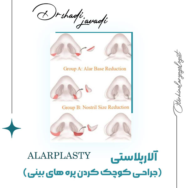 آلارپلاستی - دکتر شادی جوادی