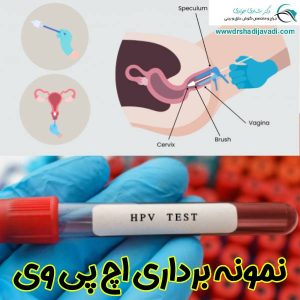 نمونه برداری اچ پی وی - دکتر شادی جوادی