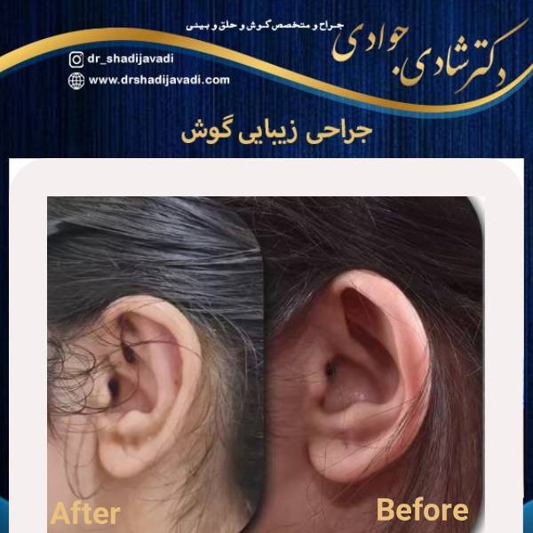عکس قبل و بعد عمل گوش - دکتر شادی جوادی