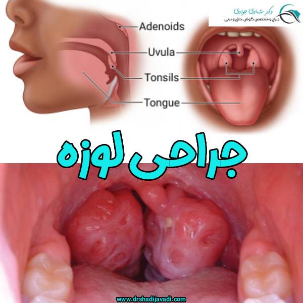 جراحی لوزه - دکتر شادی جوادی