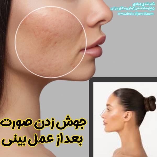 جوش صورت بعد از عمل بینی