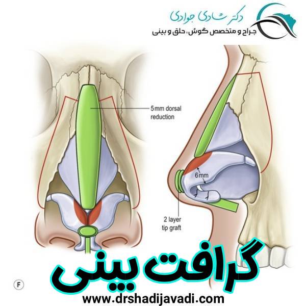 گرافت بینی - دکتر شادی جوادی
