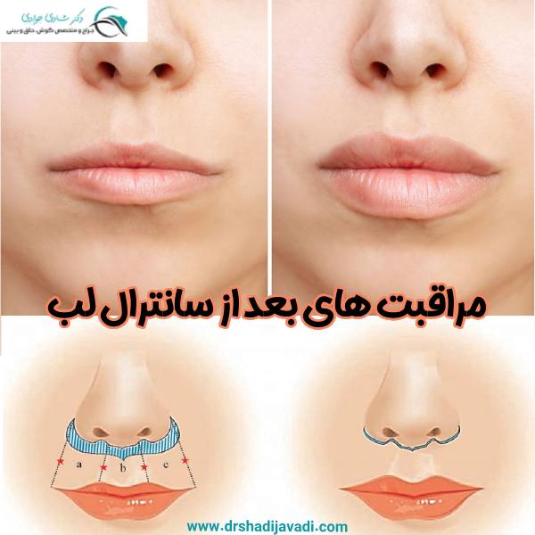 مراقبت های بعد از سانترال لب - دکتر شادی جوادی