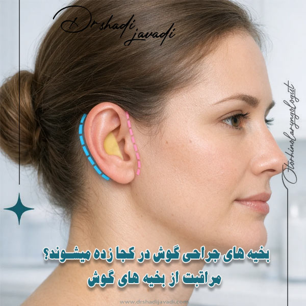 بخیه های جراحی گوش در کجا زده میشوند؟ مراقبت از بخیه های گوش