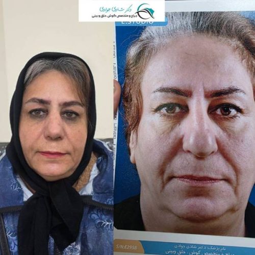 جراحی-بینی-291 (1)