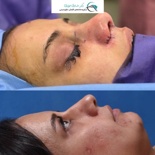جراحی-بینی-294 (1)