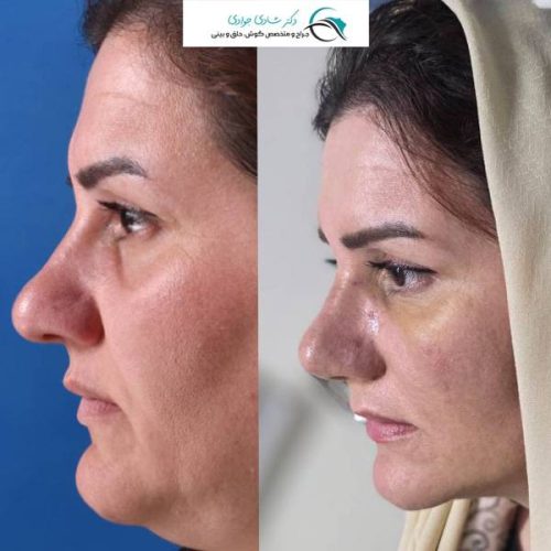 جراحی-بینی296 (1)