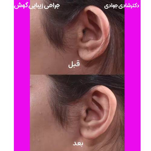 جراحی-زیبایی-گوش-26