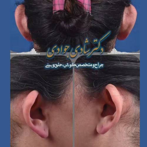 جراحی-زیبایی-گوش-28