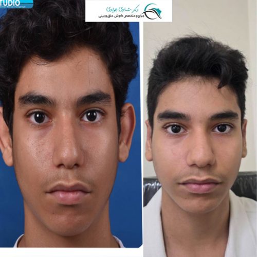 جراحی-زیبایی-گوش29