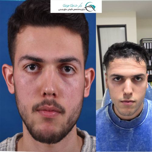 جزاحی-زیبایی-گوش31