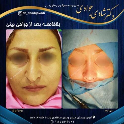 جراحی زیبایی بینی در بوشهر 14