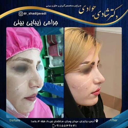 جراحی زیبایی بینی در بوشهر 8