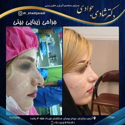 جراحی زیبایی بینی در بوشهر 9