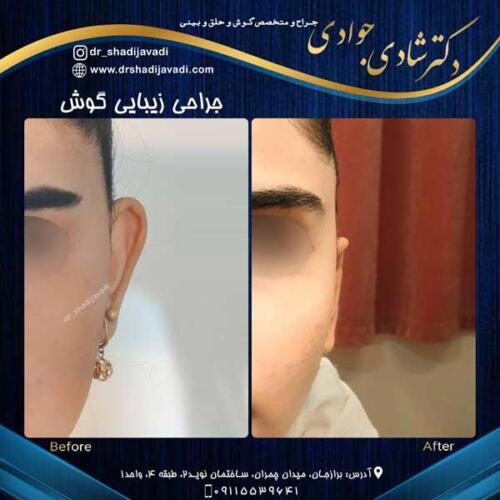 جراحی زیبایی گوش در بوشهر 8
