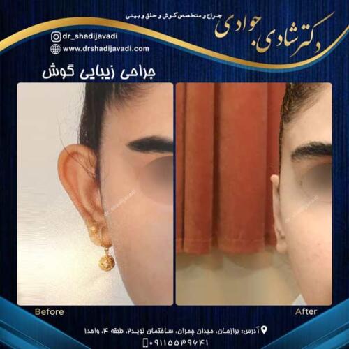 جراحی زیبایی گوش در بوشهر 9